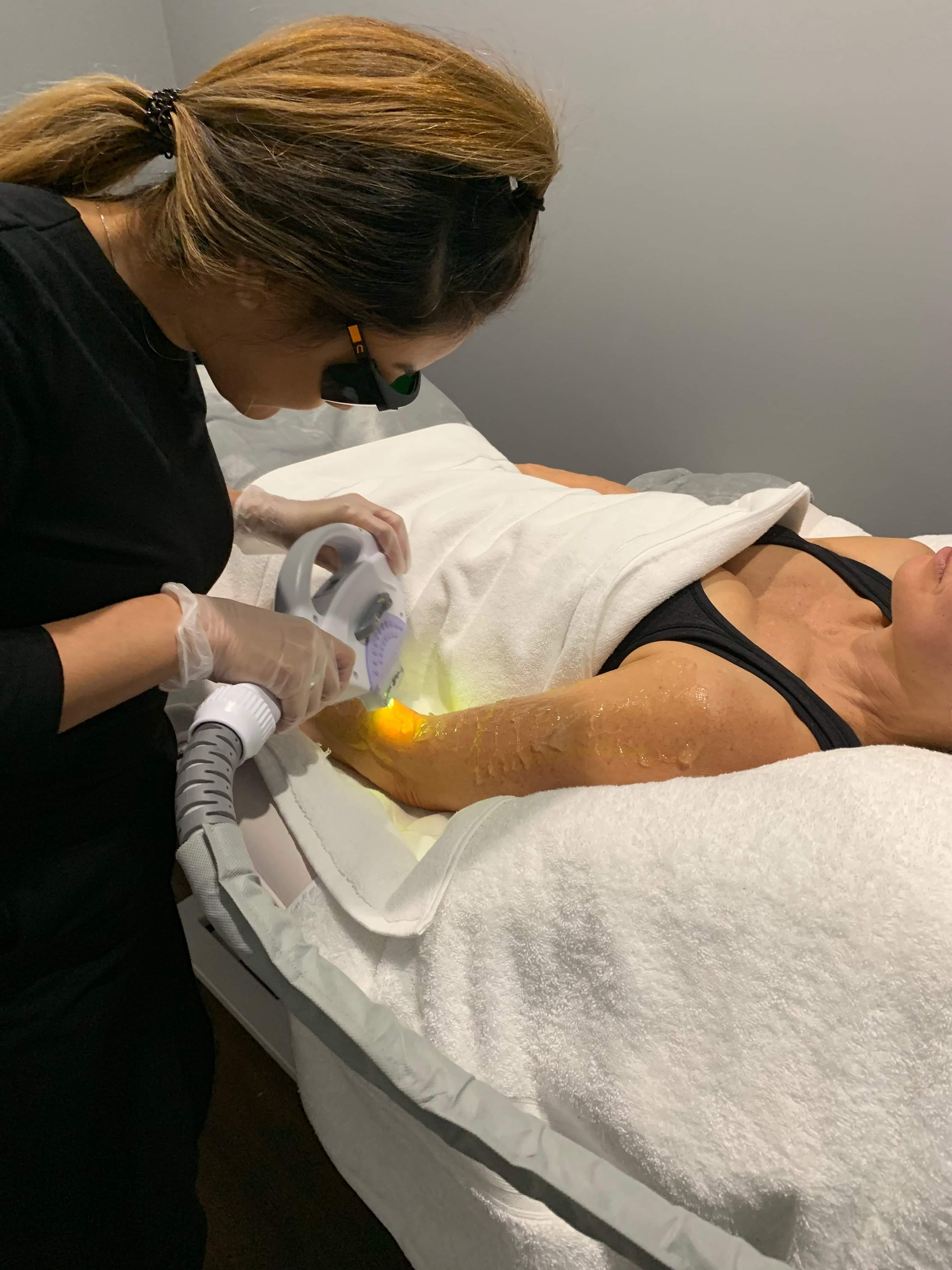 IPL laser treatments turramurra beauty salon